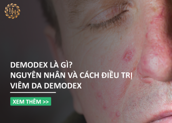 Demodex là gì? Nguyên nhân và cách điều trị viêm da Demodex