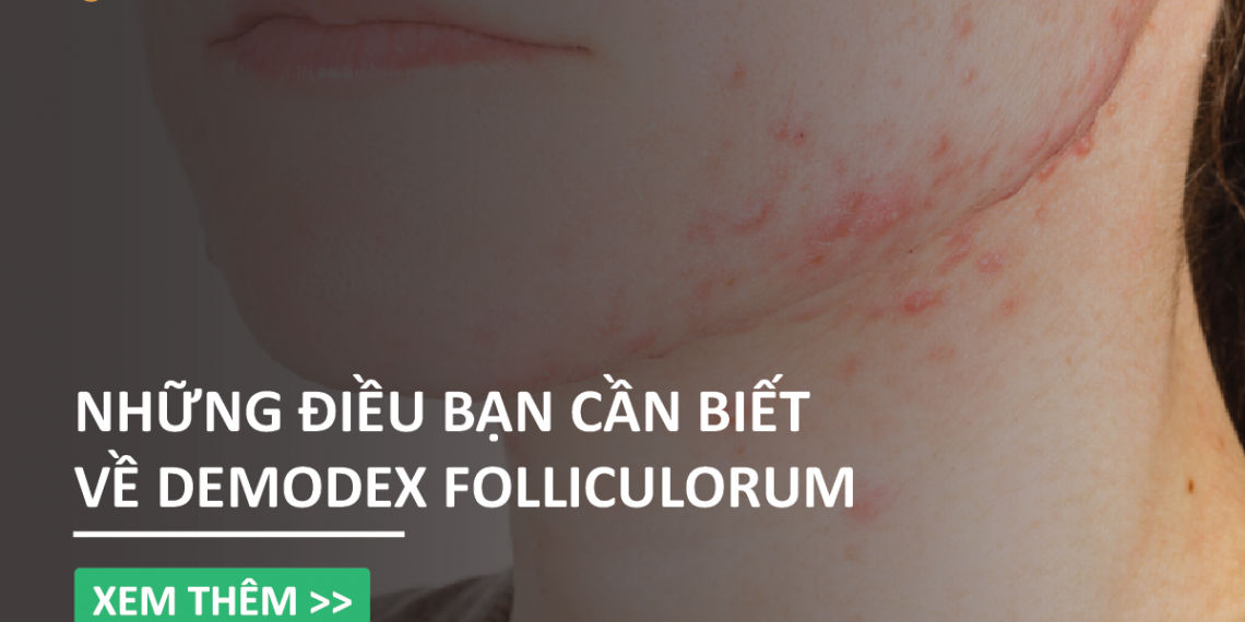 Những điều bạn cần biết về ký sinh trùng Demodex Folliculorum